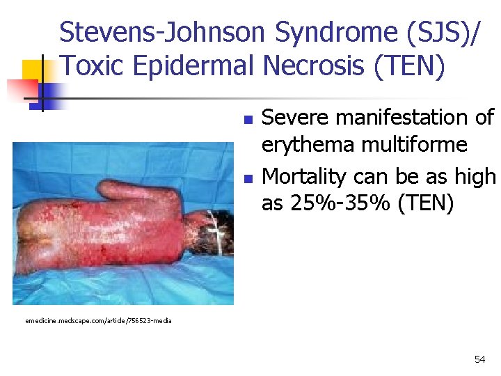 Stevens-Johnson Syndrome (SJS)/ Toxic Epidermal Necrosis (TEN) n n Severe manifestation of erythema multiforme