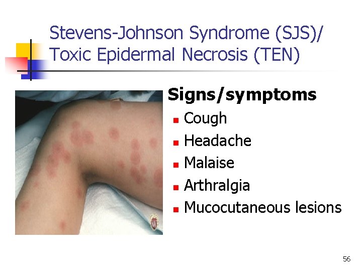 Stevens-Johnson Syndrome (SJS)/ Toxic Epidermal Necrosis (TEN) n Signs/symptoms n n n Cough Headache
