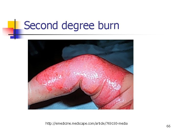 Second degree burn http: //emedicine. medscape. com/article/769193 -media 66 