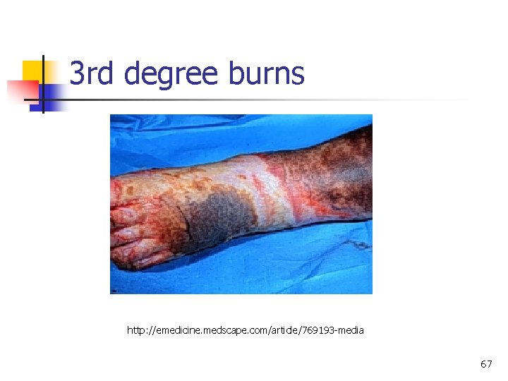 3 rd degree burns http: //emedicine. medscape. com/article/769193 -media 67 