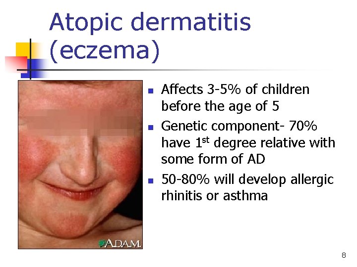 Atopic dermatitis (eczema) n n n Affects 3 -5% of children before the age