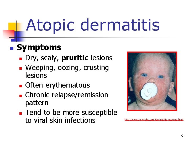 Atopic dermatitis n Symptoms n n n Dry, scaly, pruritic lesions Weeping, oozing, crusting
