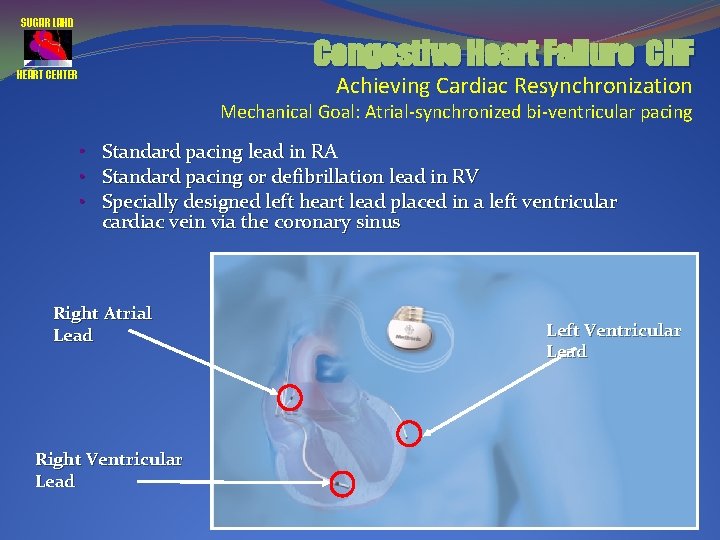 SUGAR LAND Congestive Heart Failure CHF HEART CENTER Achieving Cardiac Resynchronization Mechanical Goal: Atrial-synchronized