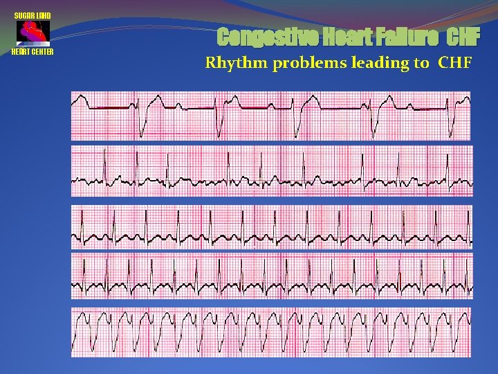 SUGAR LAND HEART CENTER Congestive Heart Failure CHF Rhythm problems leading to CHF 