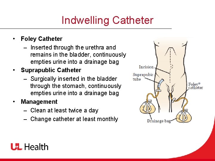Indwelling Catheter • Foley Catheter – Inserted through the urethra and remains in the