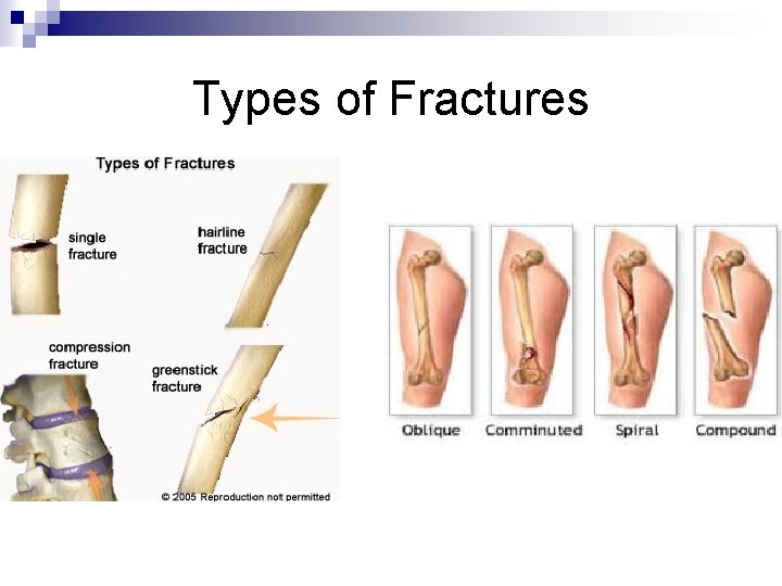 Types of Fractures 