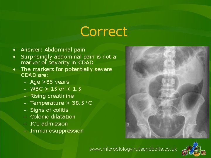 Correct • Answer: Abdominal pain • Surprisingly abdominal pain is not a marker of
