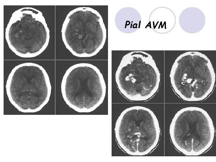 Pial AVM 59 