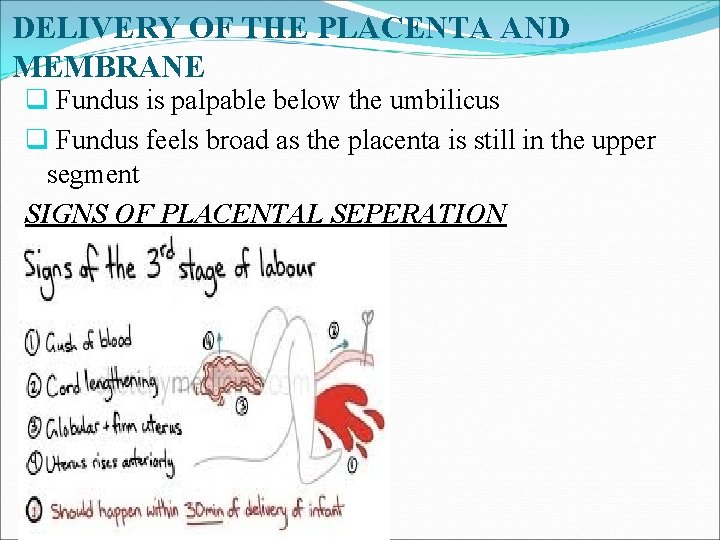 DELIVERY OF THE PLACENTA AND MEMBRANE q Fundus is palpable below the umbilicus q