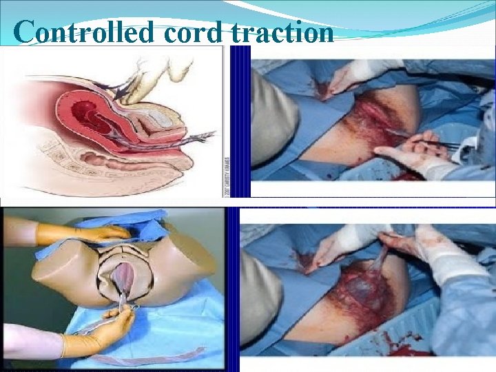 Controlled cord traction 
