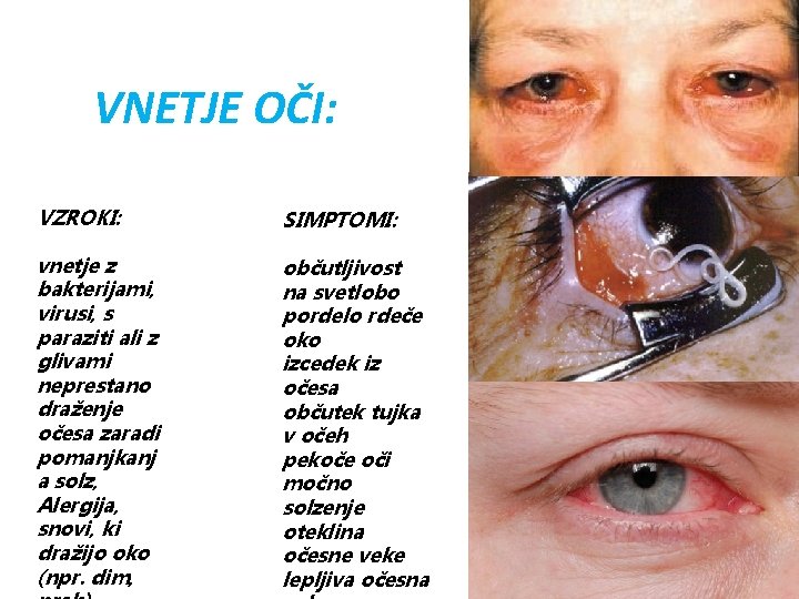 VNETJE OČI: VZROKI: SIMPTOMI: vnetje z bakterijami, virusi, s paraziti ali z glivami neprestano