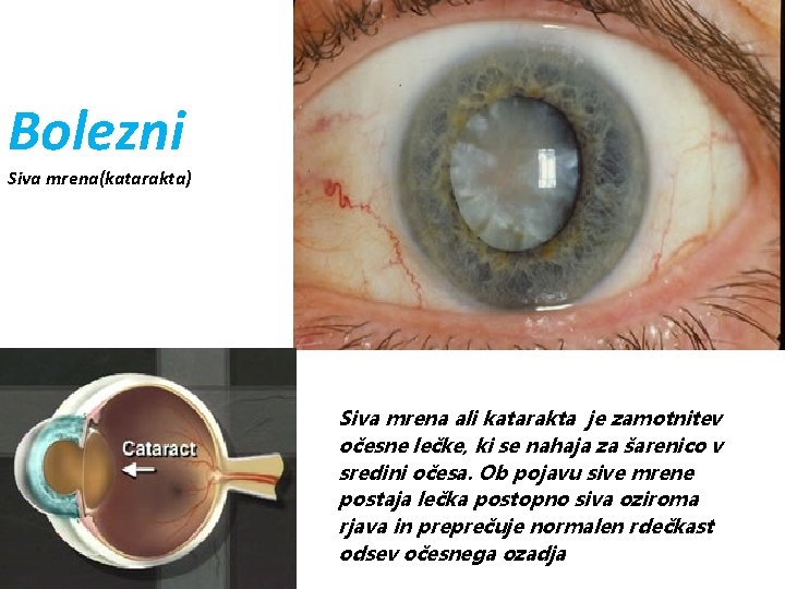 Bolezni Siva mrena(katarakta) Siva mrena ali katarakta je zamotnitev očesne lečke, ki se nahaja