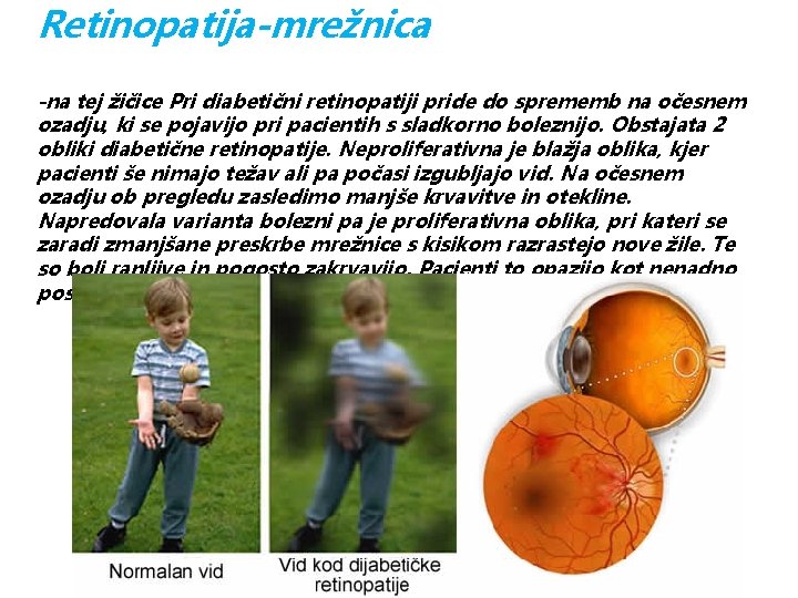 Retinopatija-mrežnica -na tej žičice Pri diabetični retinopatiji pride do sprememb na očesnem ozadju, ki