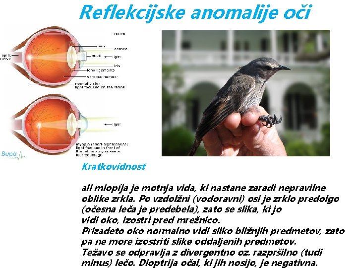 Reflekcijske anomalije oči Kratkovídnost ali miopíja je motnja vida, ki nastane zaradi nepravilne oblike