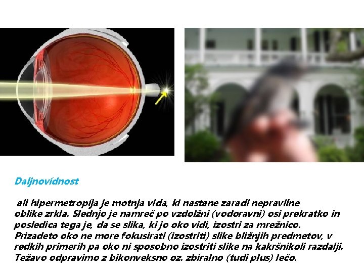 Daljnovídnost ali hipermetropíja je motnja vida, ki nastane zaradi nepravilne oblike zrkla. Slednjo je