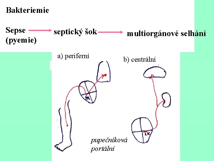 Bakteriemie Sepse (pyemie) septický šok a) periferní multiorgánové selhání b) centrální pupečníková portální 