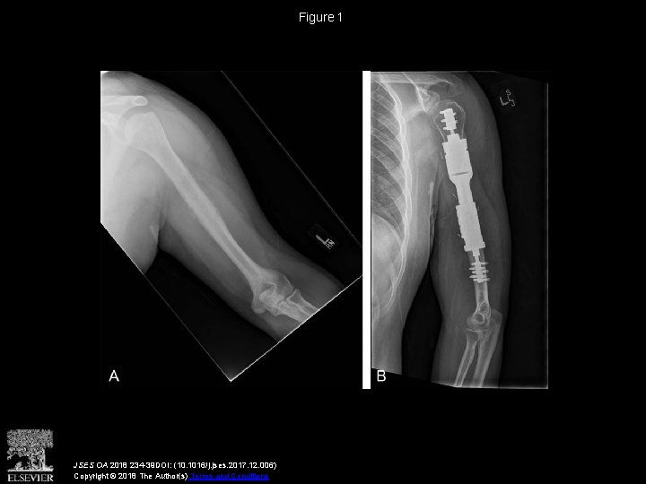 Figure 1 JSES OA 2018 234 -39 DOI: (10. 1016/j. jses. 2017. 12. 006)