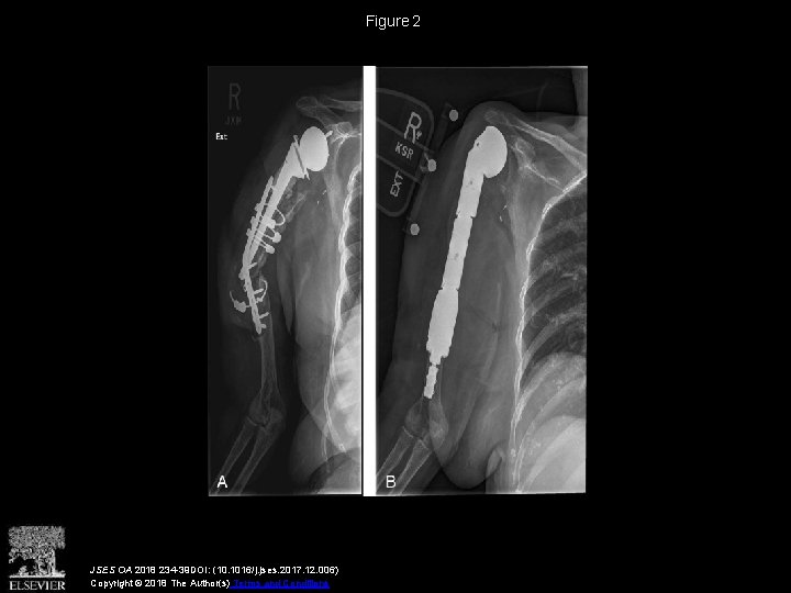 Figure 2 JSES OA 2018 234 -39 DOI: (10. 1016/j. jses. 2017. 12. 006)