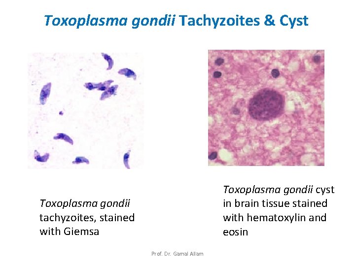 Toxoplasma gondii Tachyzoites & Cyst Toxoplasma gondii cyst in brain tissue stained with hematoxylin