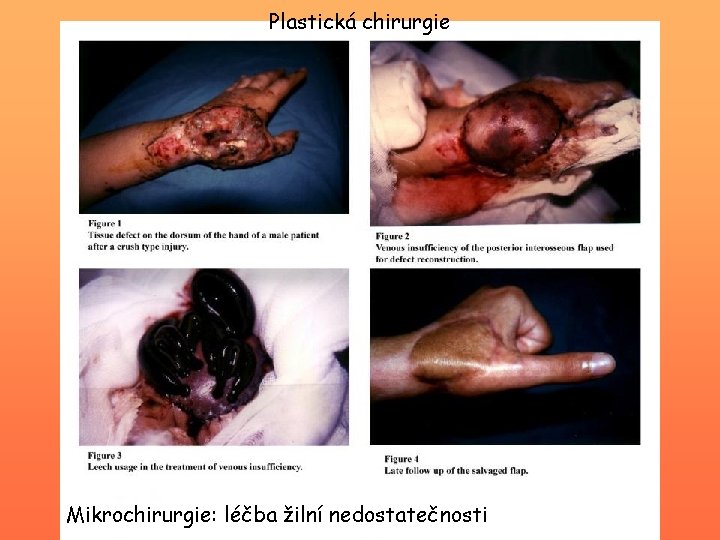 Plastická chirurgie Mikrochirurgie: léčba žilní nedostatečnosti 