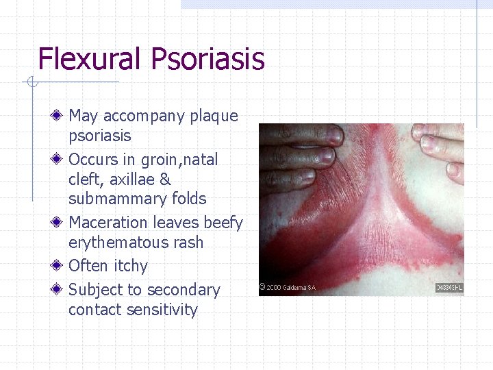 Flexural Psoriasis May accompany plaque psoriasis Occurs in groin, natal cleft, axillae & submammary