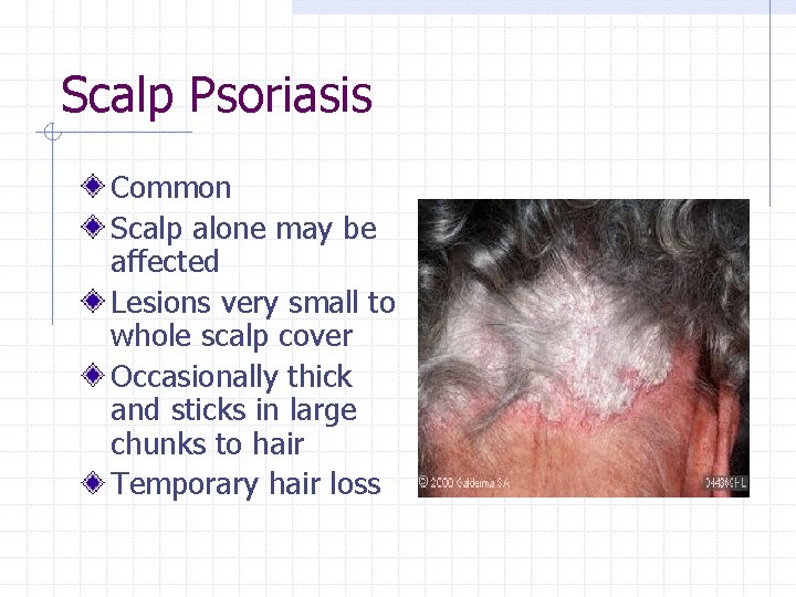 Scalp Psoriasis Common Scalp alone may be affected Lesions very small to whole scalp
