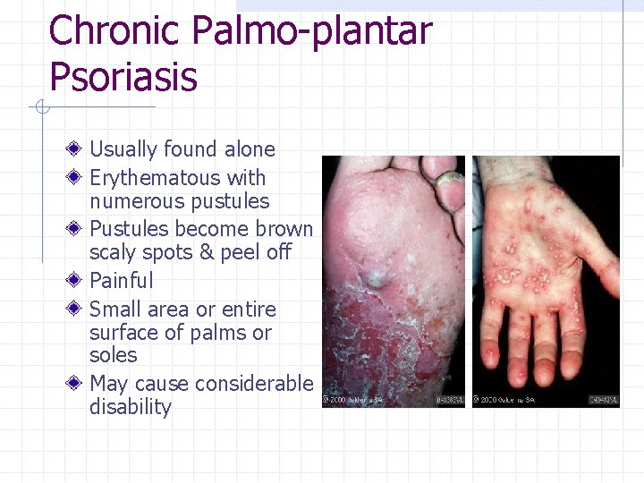 Chronic Palmo-plantar Psoriasis Usually found alone Erythematous with numerous pustules Pustules become brown scaly