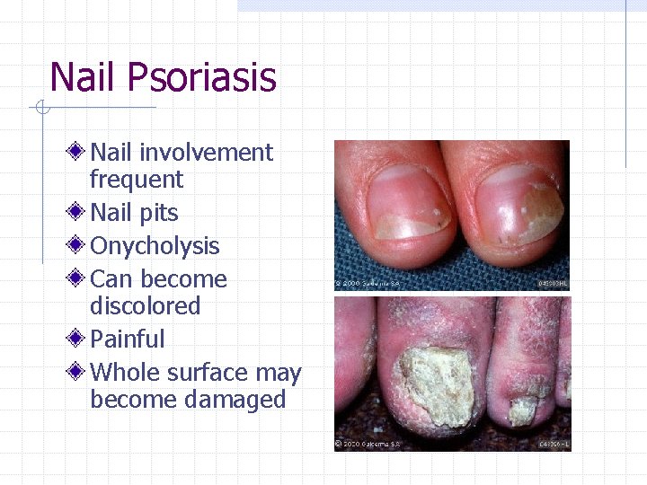 Nail Psoriasis Nail involvement frequent Nail pits Onycholysis Can become discolored Painful Whole surface