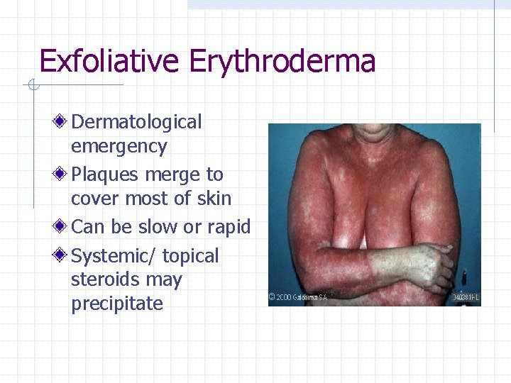 Exfoliative Erythroderma Dermatological emergency Plaques merge to cover most of skin Can be slow