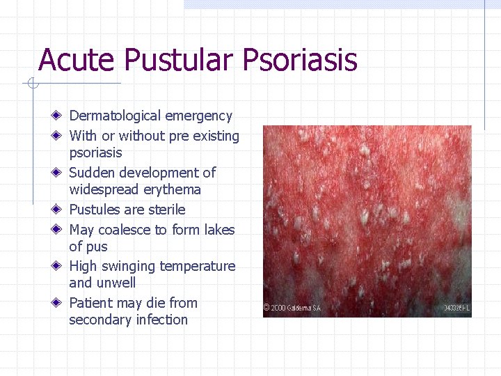 Acute Pustular Psoriasis Dermatological emergency With or without pre existing psoriasis Sudden development of