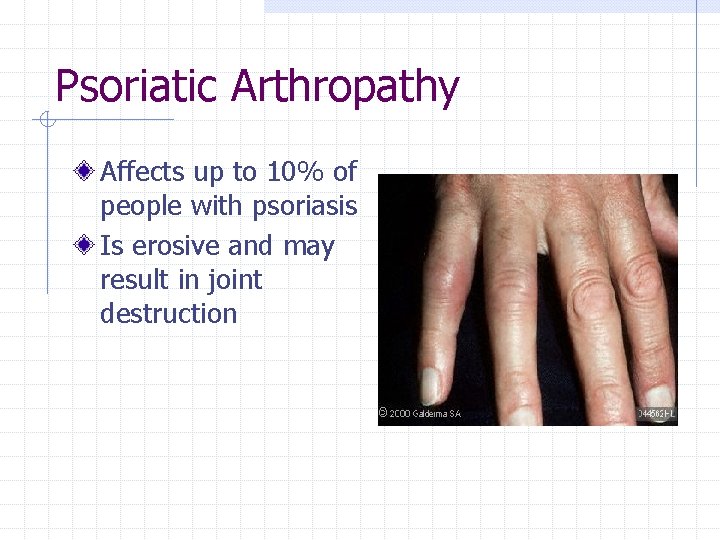 Psoriatic Arthropathy Affects up to 10% of people with psoriasis Is erosive and may