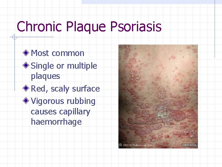Chronic Plaque Psoriasis Most common Single or multiple plaques Red, scaly surface Vigorous rubbing