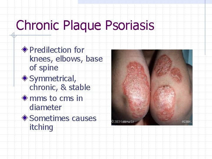 Chronic Plaque Psoriasis Predilection for knees, elbows, base of spine Symmetrical, chronic, & stable