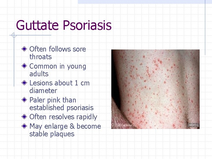 Guttate Psoriasis Often follows sore throats Common in young adults Lesions about 1 cm