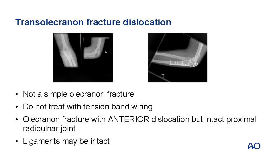 Transolecranon fracture dislocation • Not a simple olecranon fracture • Do not treat with