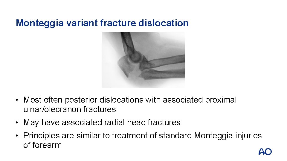 Monteggia variant fracture dislocation • Most often posterior dislocations with associated proximal ulnar/olecranon fractures