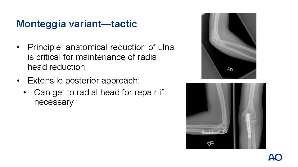 Monteggia variant—tactic • Principle: anatomical reduction of ulna is critical for maintenance of radial