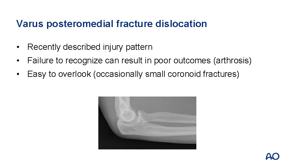 Varus posteromedial fracture dislocation • Recently described injury pattern • Failure to recognize can