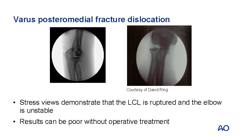 Varus posteromedial fracture dislocation Courtesy of David Ring • Stress views demonstrate that the