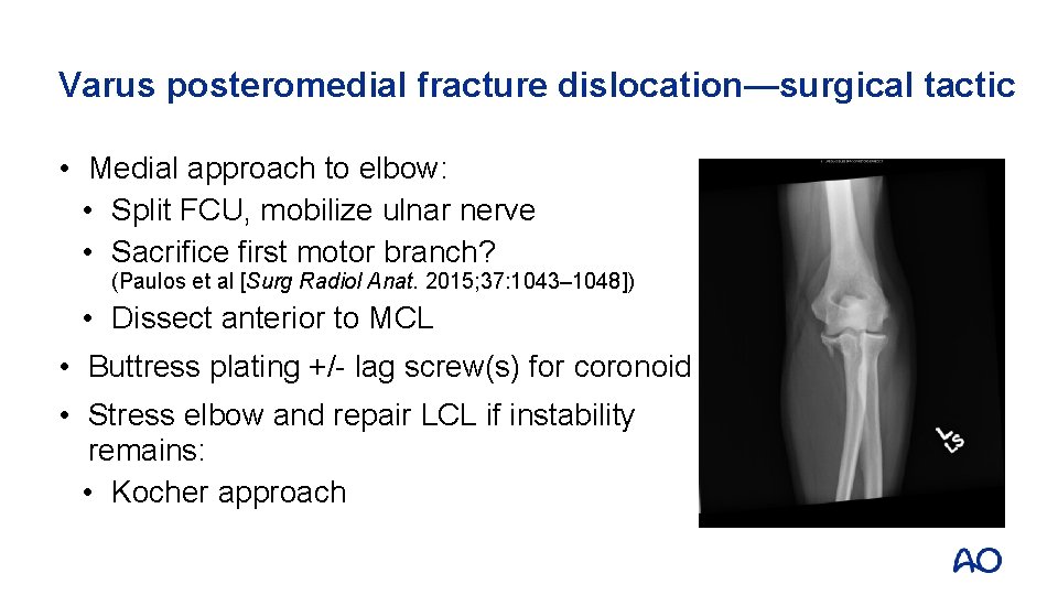 Varus posteromedial fracture dislocation—surgical tactic • Medial approach to elbow: • Split FCU, mobilize