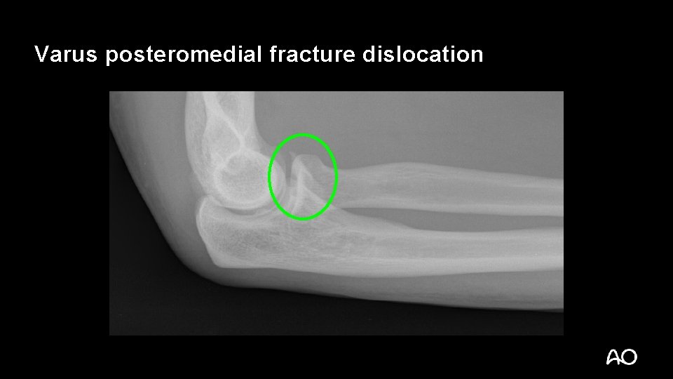Varus posteromedial fracture dislocation 