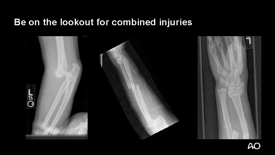 Be on the lookout for combined injuries 