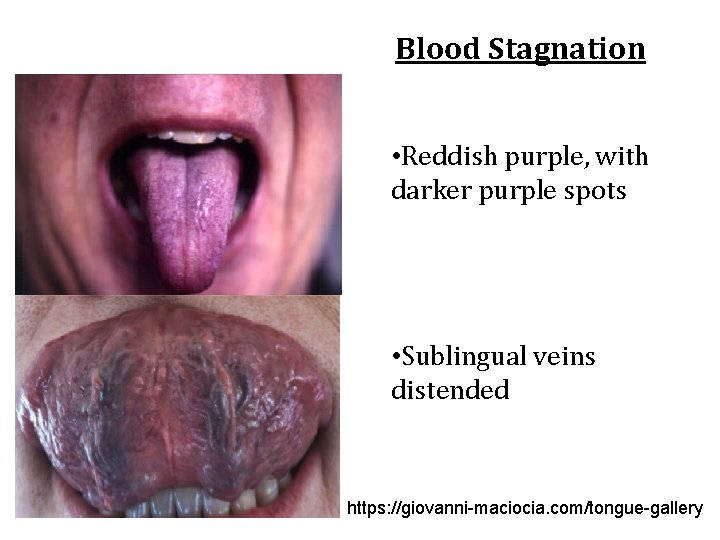 Blood Stagnation • Reddish purple, with darker purple spots • Sublingual veins distended https: