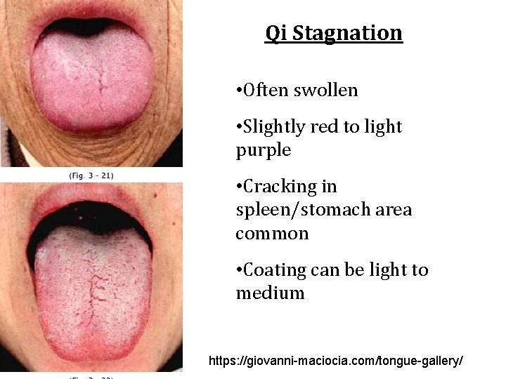 Qi Stagnation • Often swollen • Slightly red to light purple • Cracking in