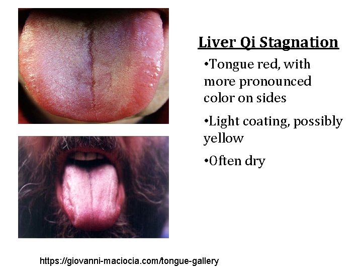 Liver Qi Stagnation • Tongue red, with more pronounced color on sides • Light