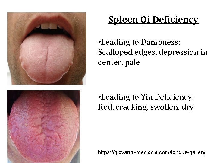 Spleen Qi Deficiency • Leading to Dampness: Scalloped edges, depression in center, pale •