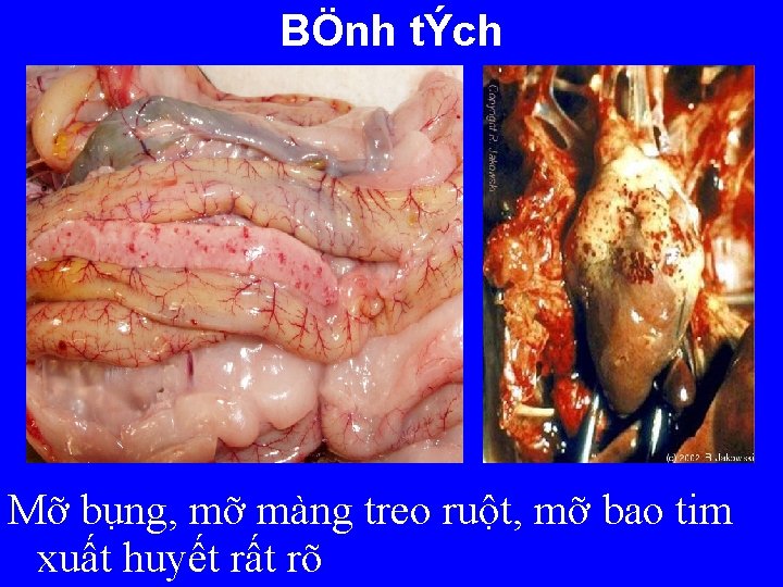 BÖnh tÝch Mỡ bụng, mỡ màng treo ruột, mỡ bao tim xuất huyết rất