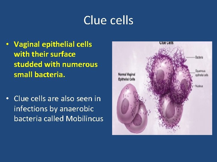 Clue cells • Vaginal epithelial cells with their surface studded with numerous small bacteria.