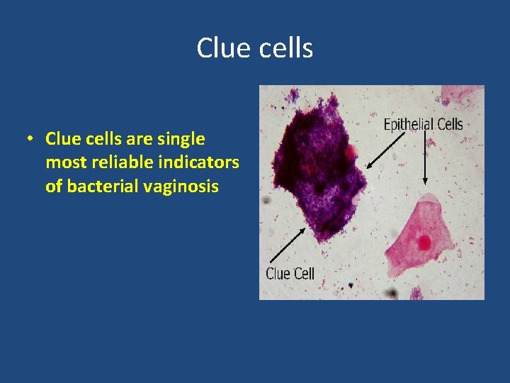 Clue cells • Clue cells are single most reliable indicators of bacterial vaginosis 