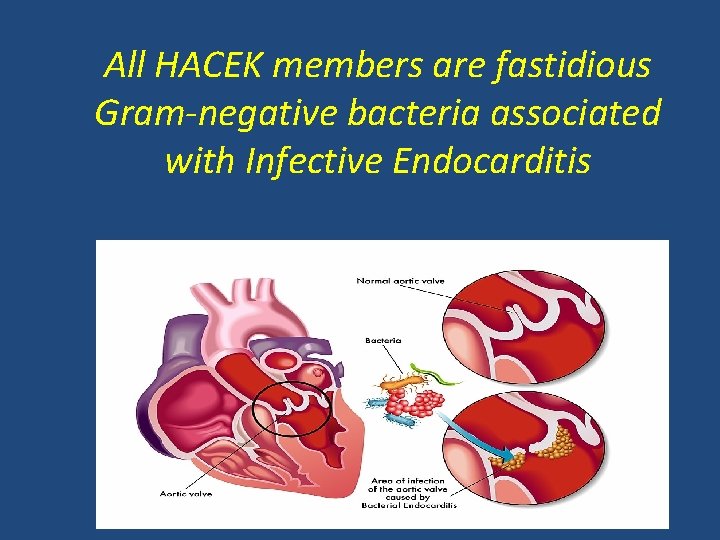 All HACEK members are fastidious Gram-negative bacteria associated with Infective Endocarditis 